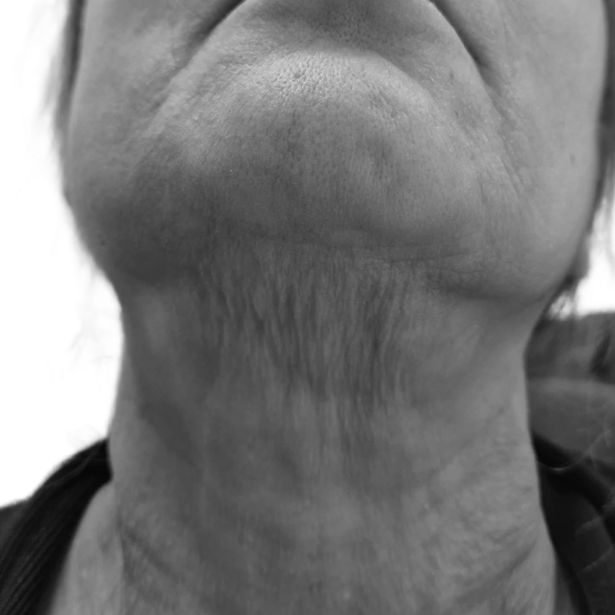 Halslyft – före
