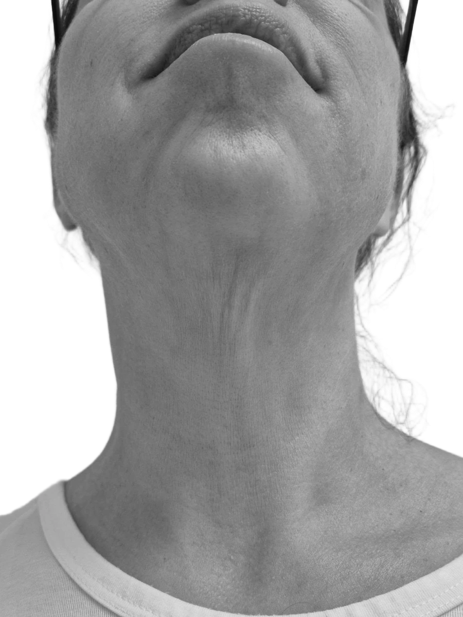 Halslyft – före